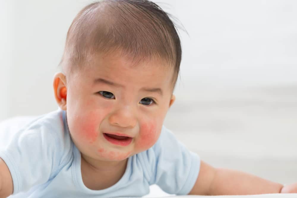 Крапивница: острая аллергия у младенцев
