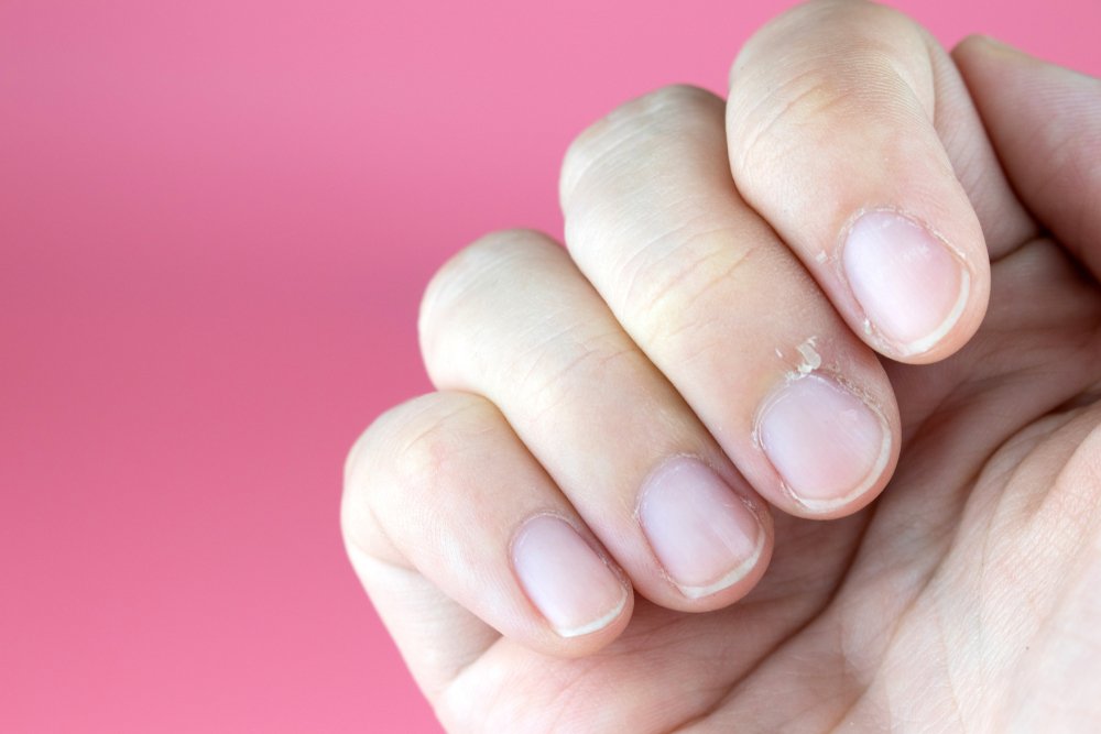 5. Привычка грызть ногти