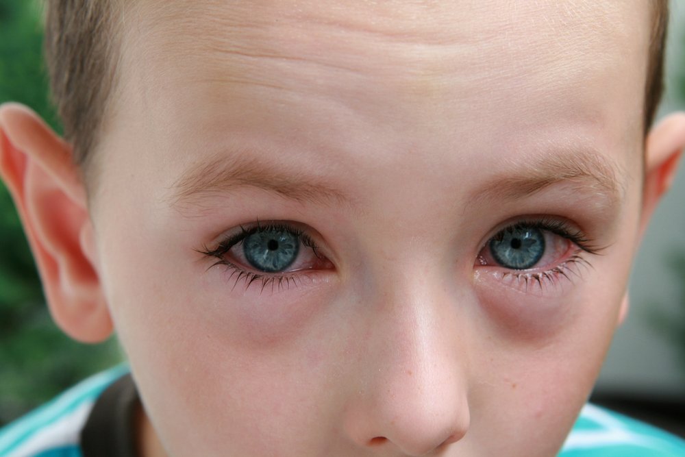 Аллергический конъюнктивит у детей фото симптомы