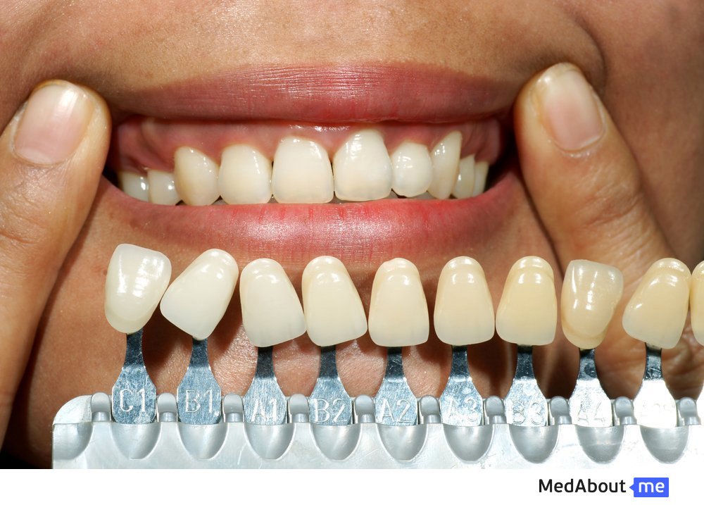 Как проходит имплантация зубов