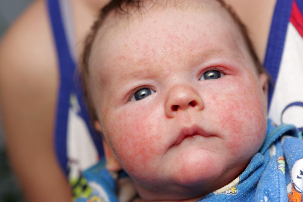 Откуда берутся аллергии у малышей?