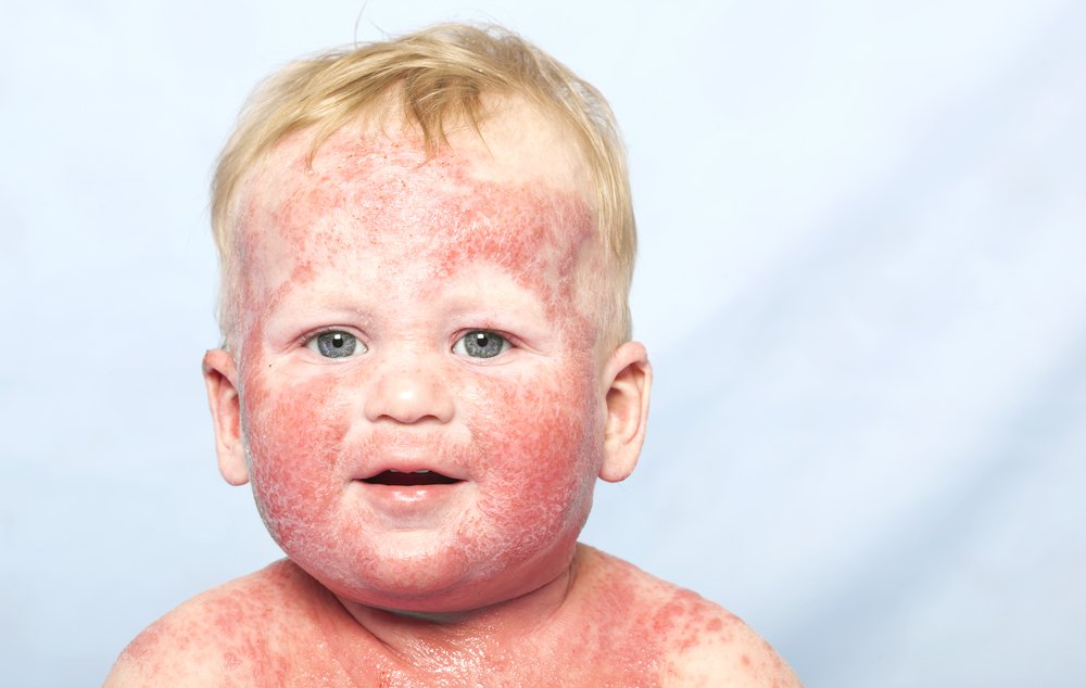 Солнечный дерматит лечение у детей фото