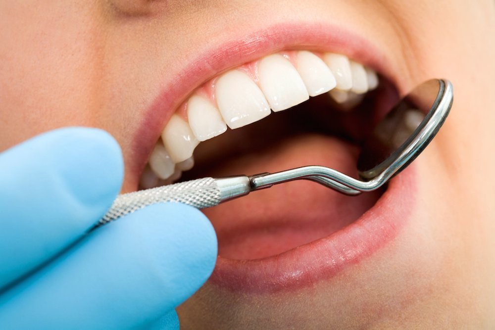 Стоматологи о зубном налете