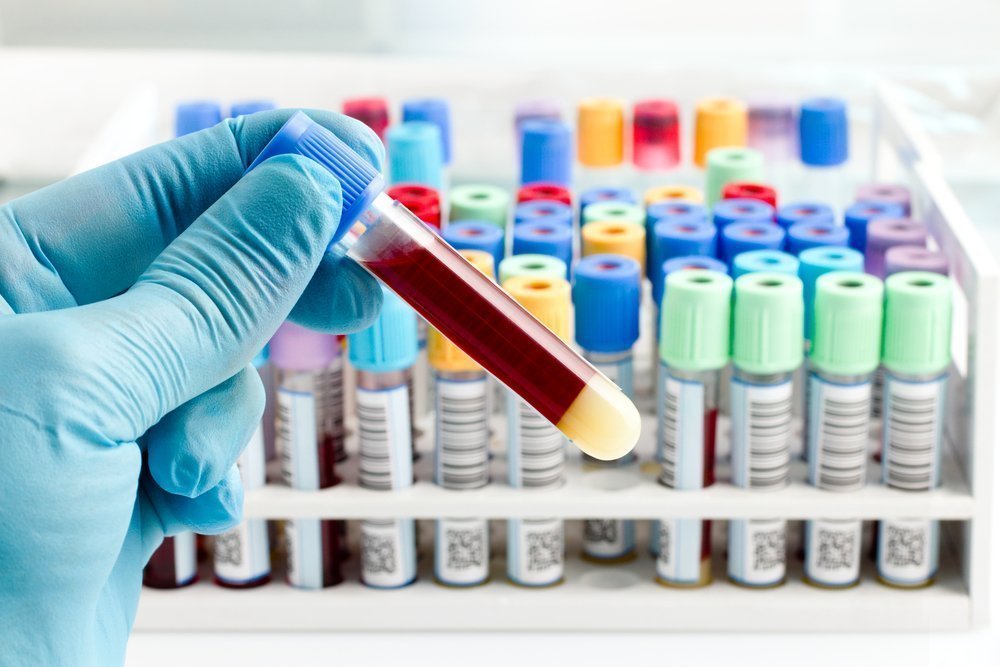 Исследования крови: биохимия, уровень холестерина