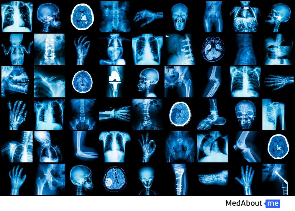 Рентгенография: особенности исследования, информативность, противопоказания