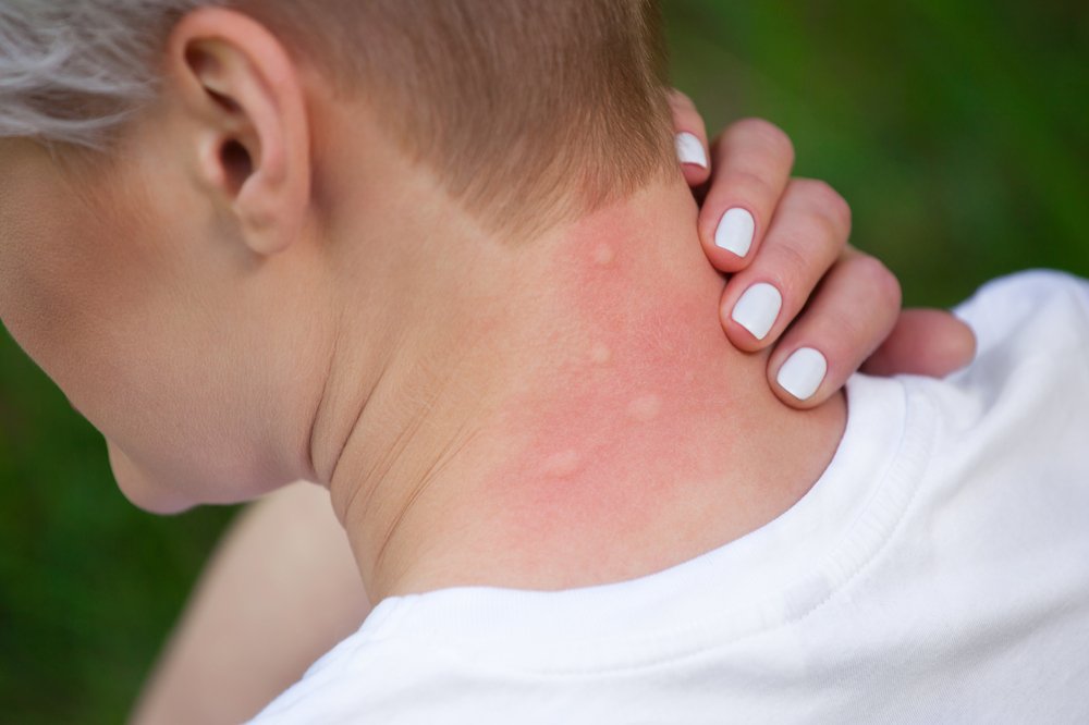Может быть у ребенка аллергия на вшей