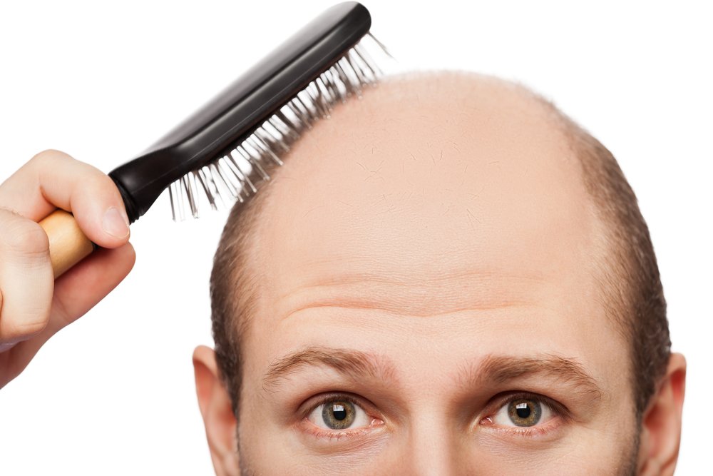 Выпадение волос: классификация алопеции