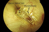 Импланты в сетчатку глаза thumbnail