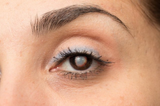 Болезни глаз: глаукома и катаракта