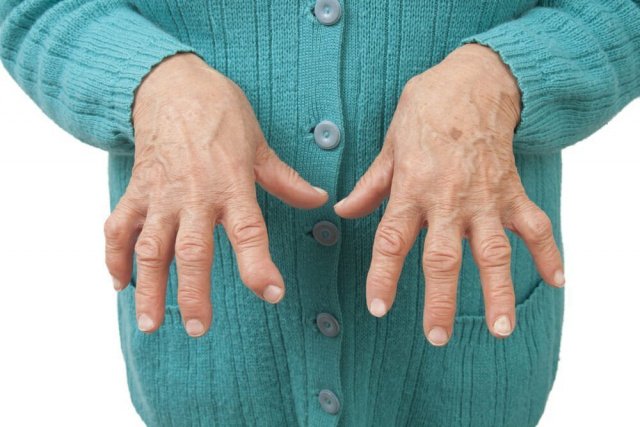 Ревматоидный артрит - симптомы и лечение