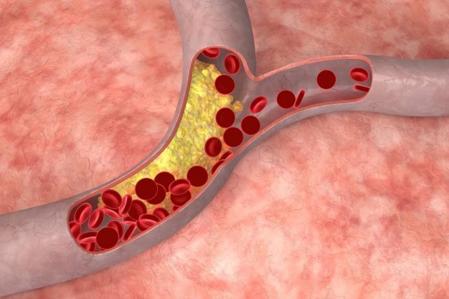 Профилактика атеросклероза артерий: диета, добавки