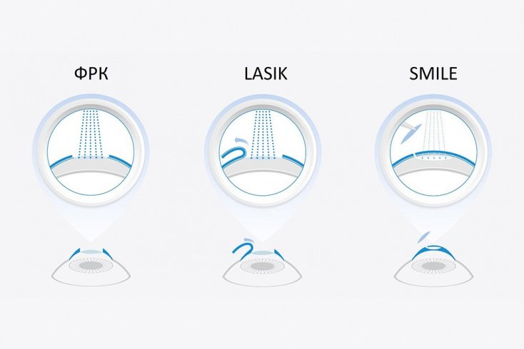 Метод ReLEX SMILE: современное решение Метод ReLEX SMILE: современное решение