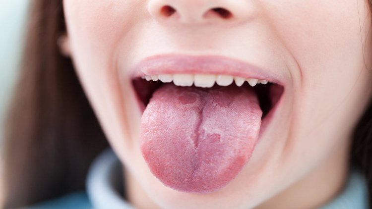 Псориаз в полости рта: симптомы