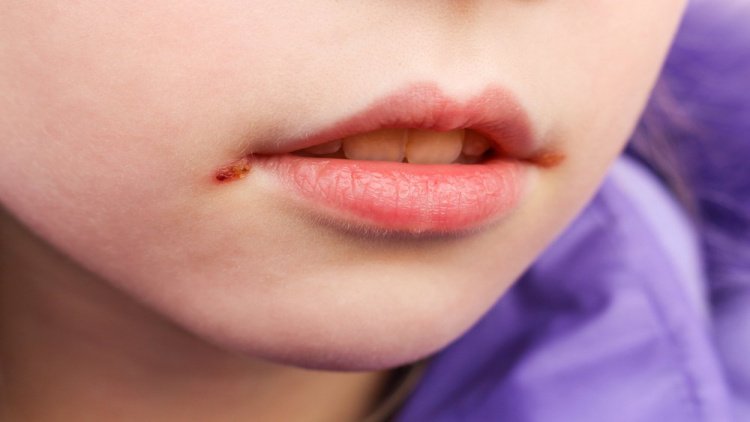 Заеды в уголках рта: быстрое лечение атопического хейлита