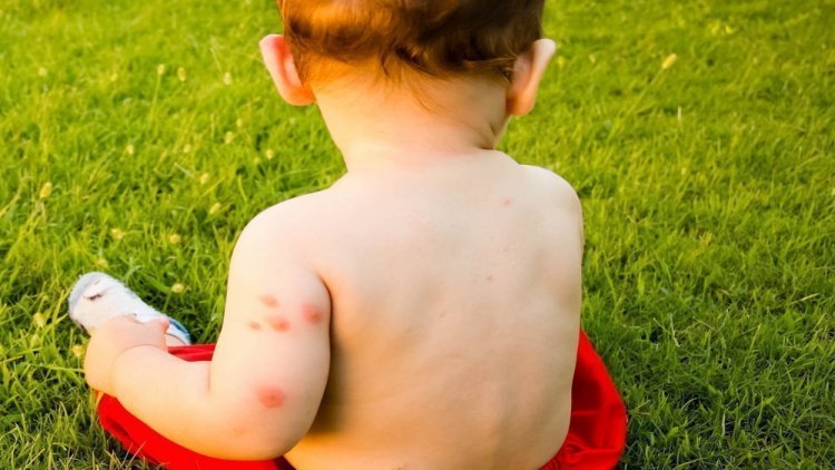 Комары и мошки: зуд кожи и расчесы