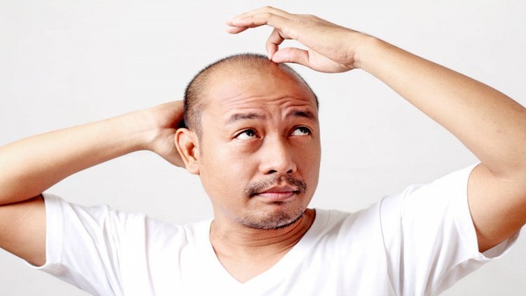 I sintomi dell'alopecia