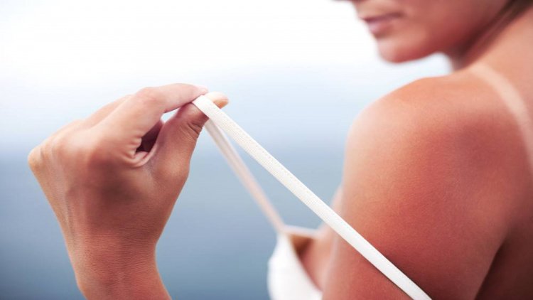 Солнечный ожог: когда здоровье кожи под угрозой?