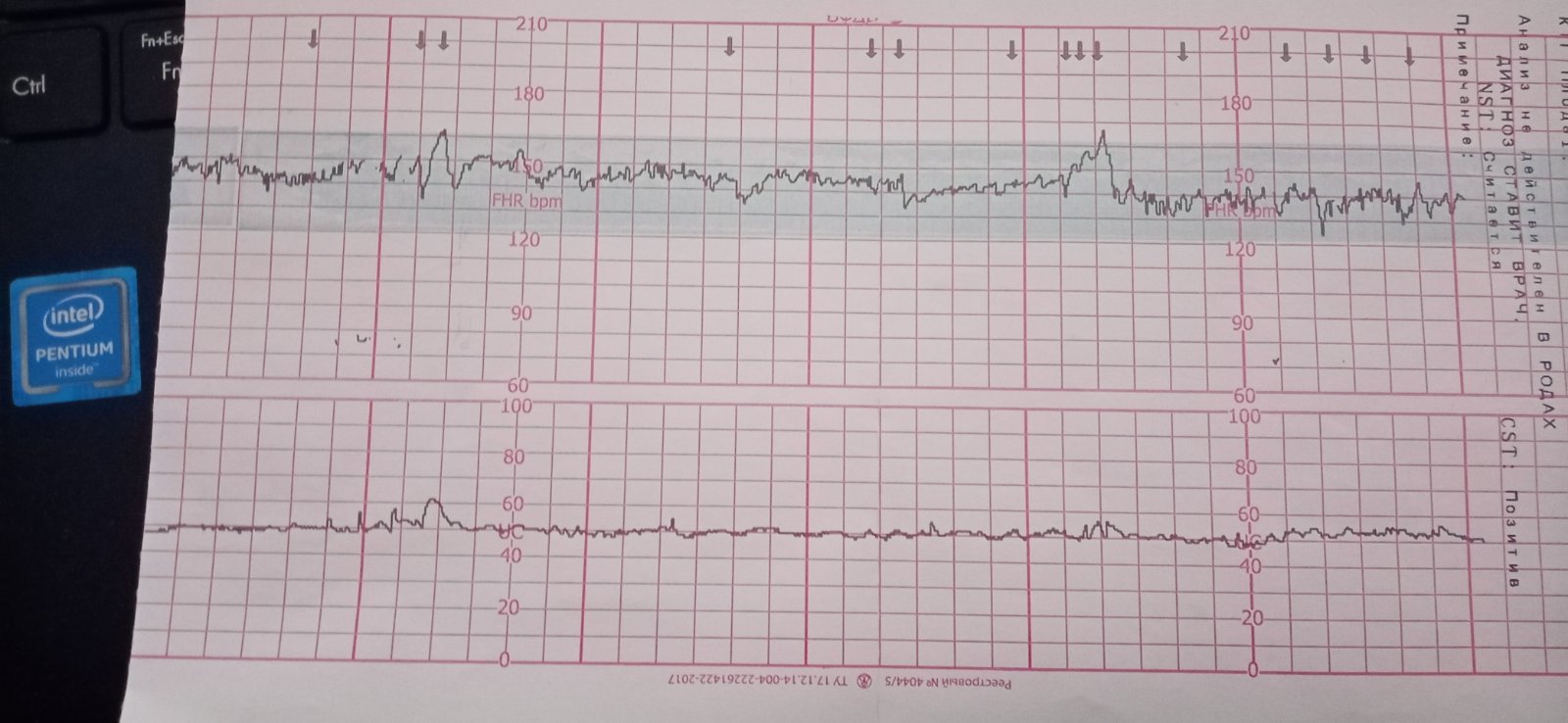 Ктг ребенка