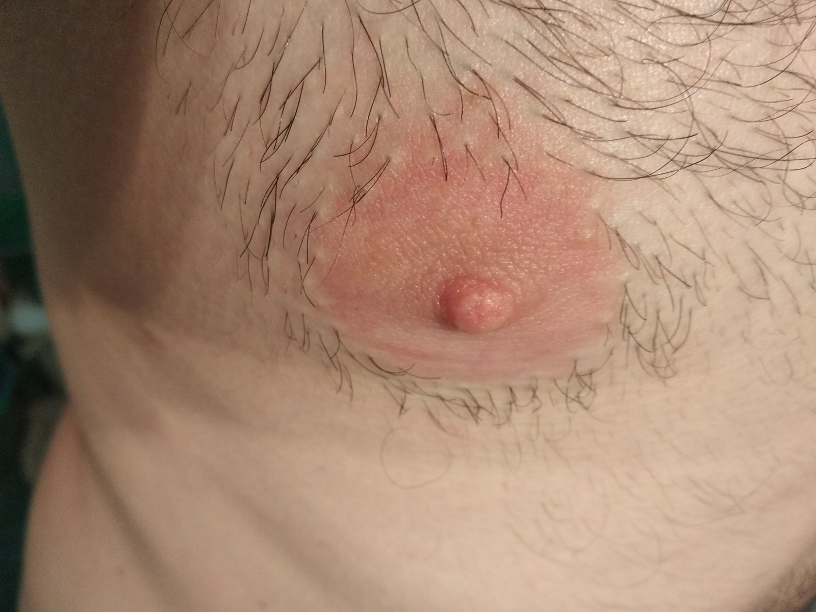 воспаление сосков на груди женщин фото 32