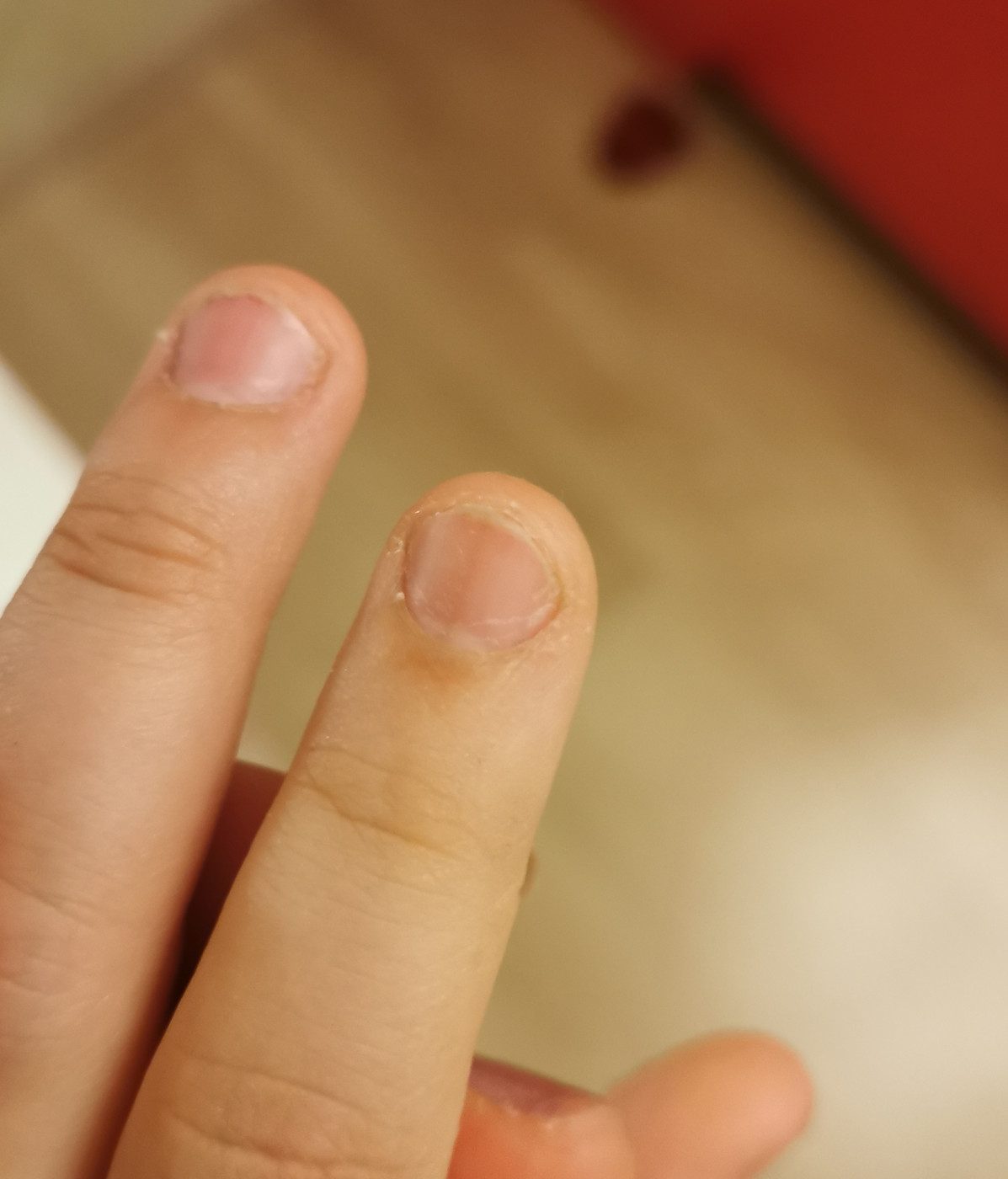 Темные полоски на ногтях назвали признаком проблем со здоровьем