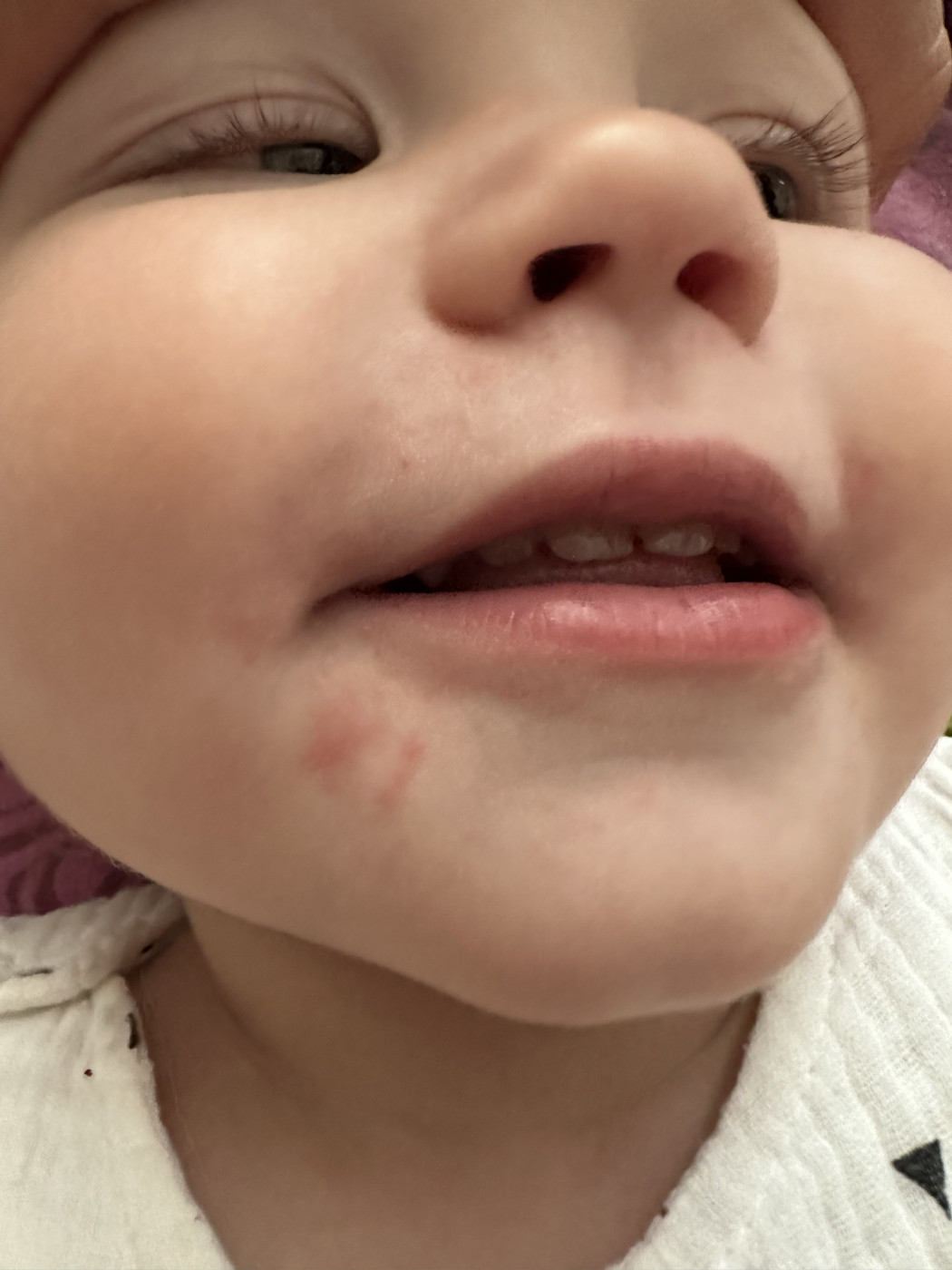 Сыпь вокруг рта — 23 ответов | форум Babyblog