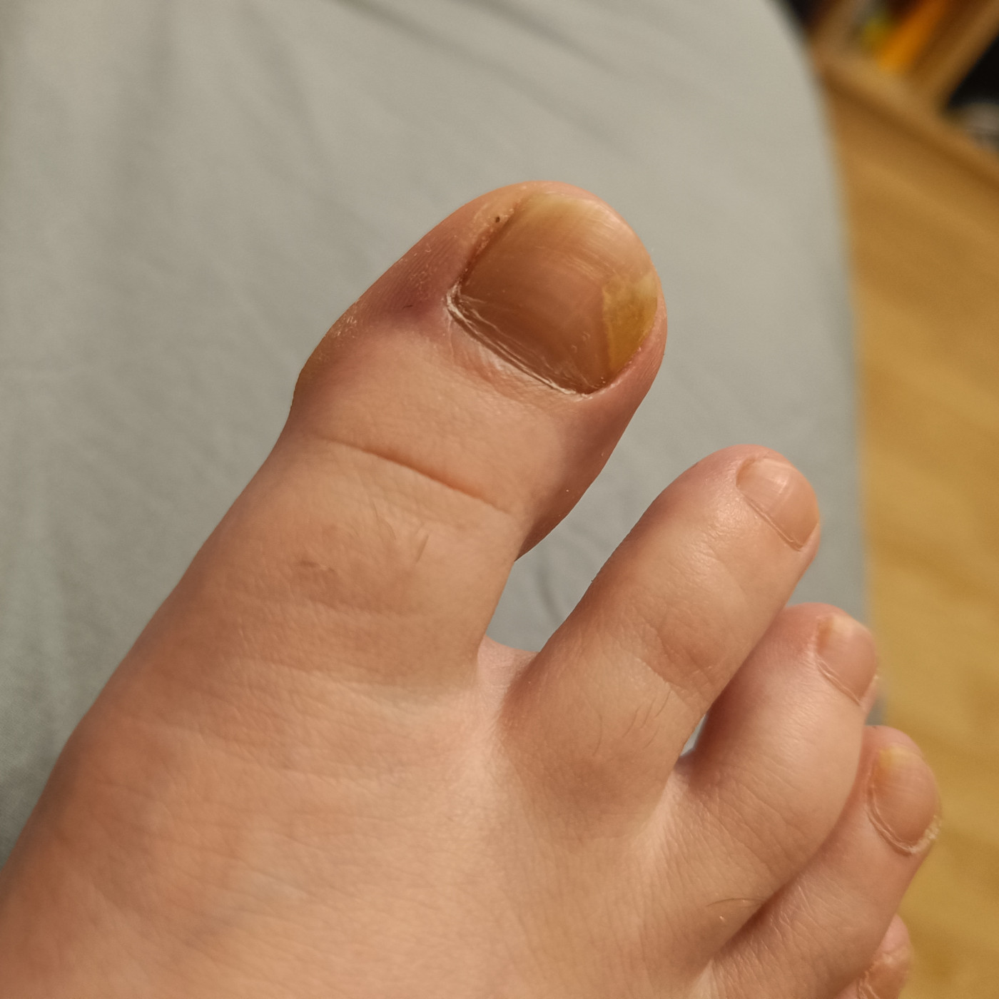 Коричневое пятно под ногтем на ноге