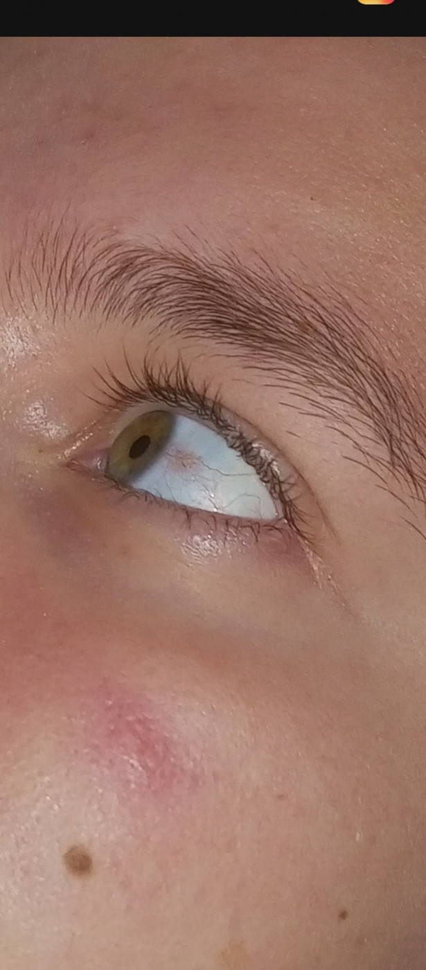 Красные пятна в глазах - почему краснеют и болят глаза?
