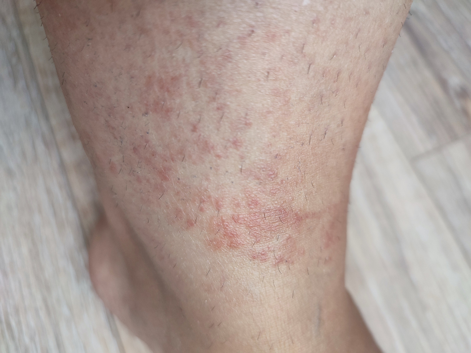 Почему появляется сыпь на ноге в виде красных точек