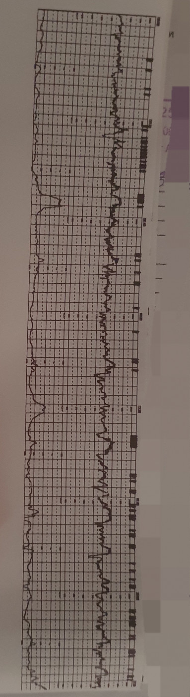 Кардиотокография плода (КТГ) при беременности – цена в Москве в клиническом госпитале на Яузе