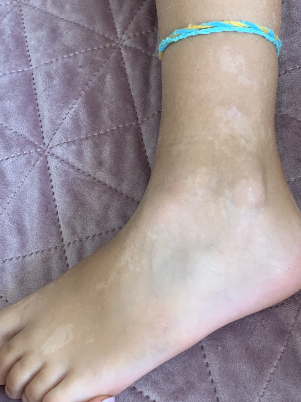Белые пятна на ноге Здравствуйте!появились у дочери 9 лет такие пятна | MedAboutMe