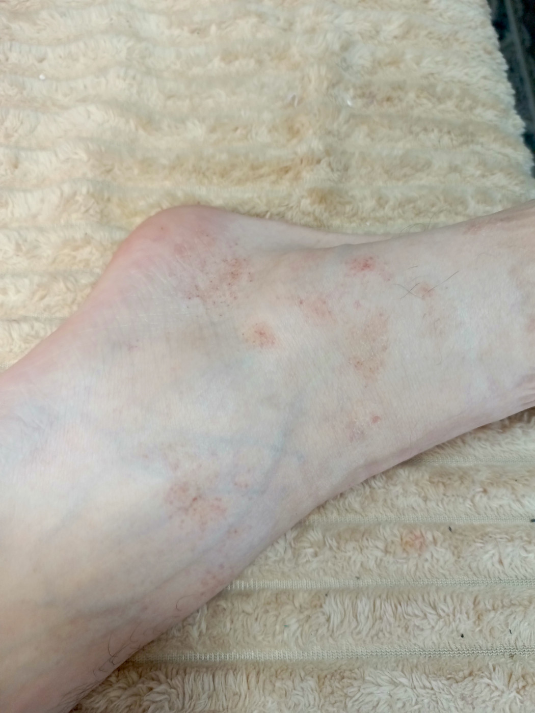 Красные пятна на ногах Пятна на ногах | MedAboutMe
